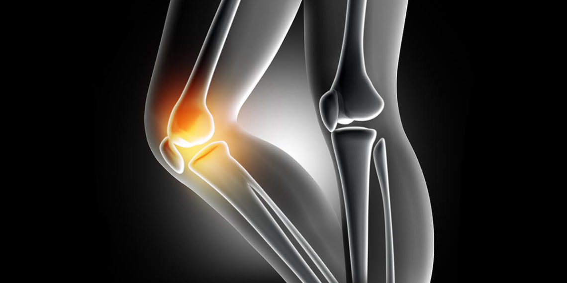 Budowa anatomiczna kolana może być czynnikiem ryzyka uszkodzeń więzadła krzyżowego przedniego – ACL