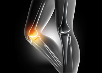 Budowa anatomiczna kolana może być czynnikiem ryzyka uszkodzeń więzadła krzyżowego przedniego – ACL