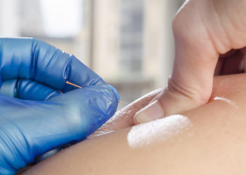 Igłoterapia mięśniowo-powięziowych punktów spustowych.